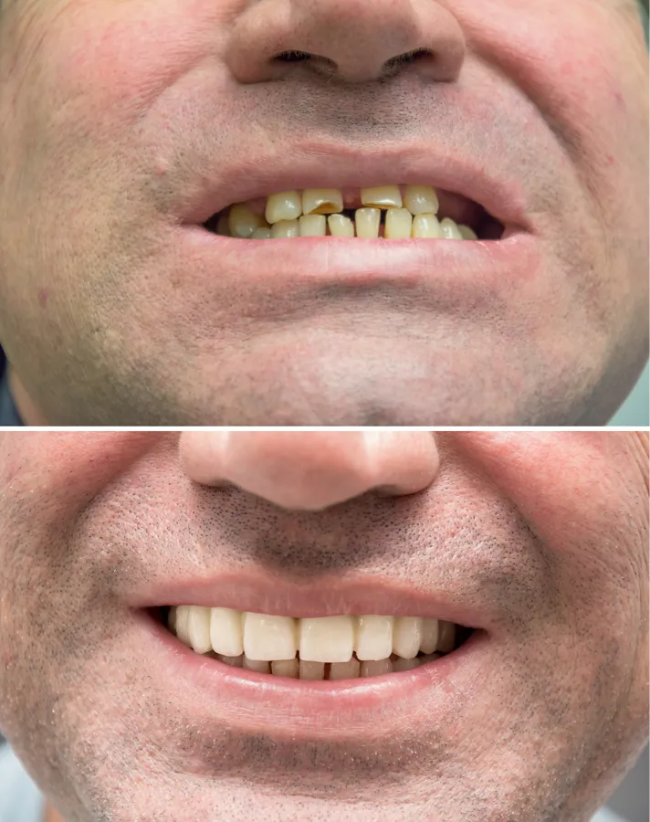 Damaged Teeth