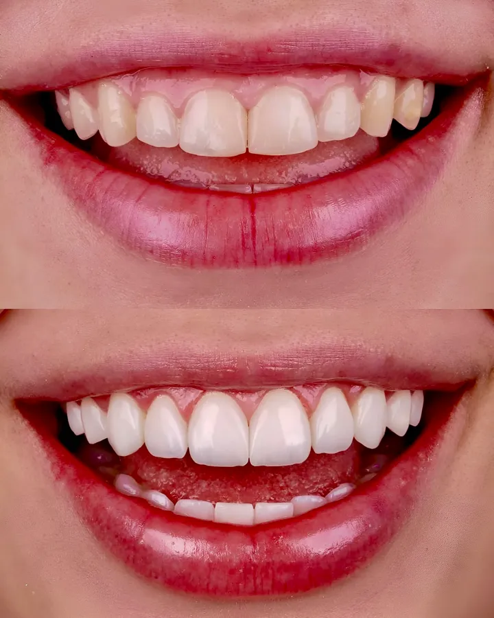 Gummy Smile