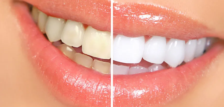 Teeth Whitening