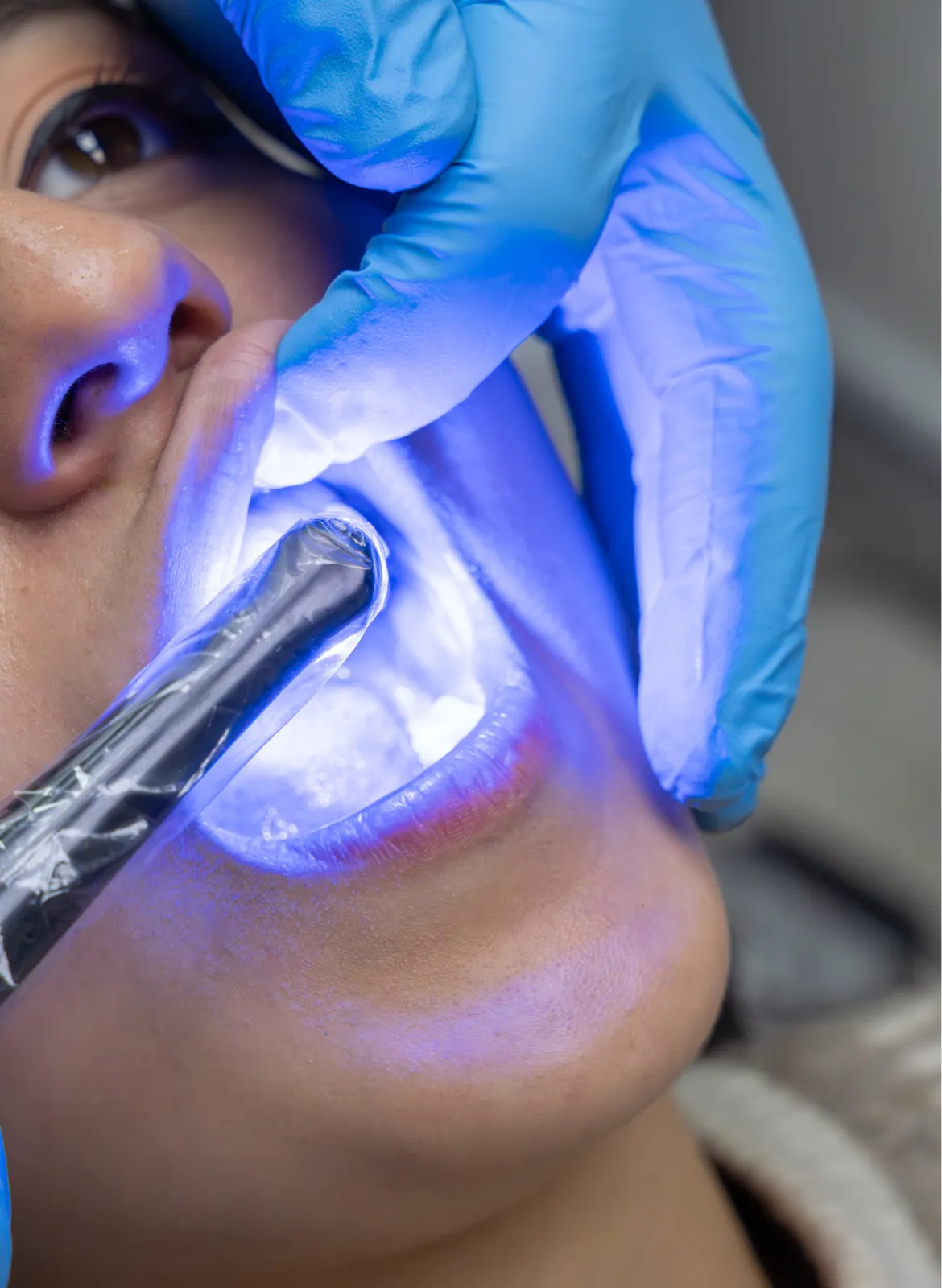 Coloured Fillings